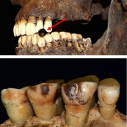 Archaeological teeth samples displaying evidence of smoking damage